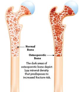 Understanding Osteoporosis