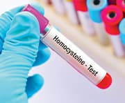 Homocysteine blood test