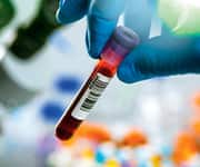 Homocysteine blood test