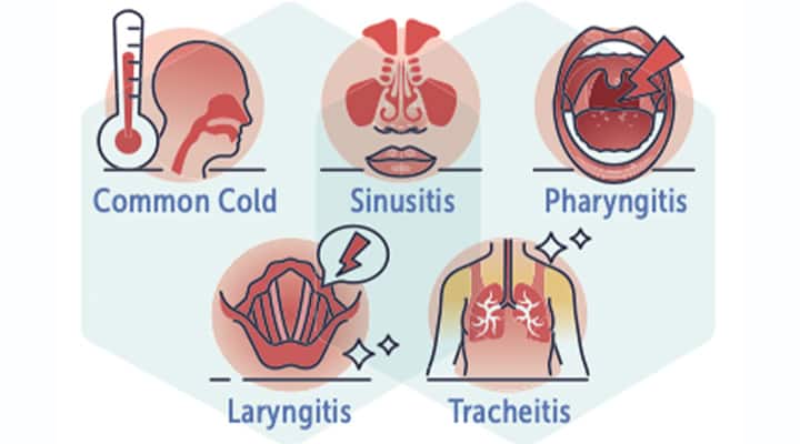 Upper respiratory tract infections