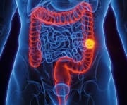Over the last few decades, an increasing number of adults under 50 have been diagnosed with colon cancer.