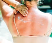 The sun's ultraviolet (UV) rays damage DNA, accelerating photoaging of the skin and increasing skin cancer risk.