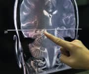 Folate Slows Brain Aging